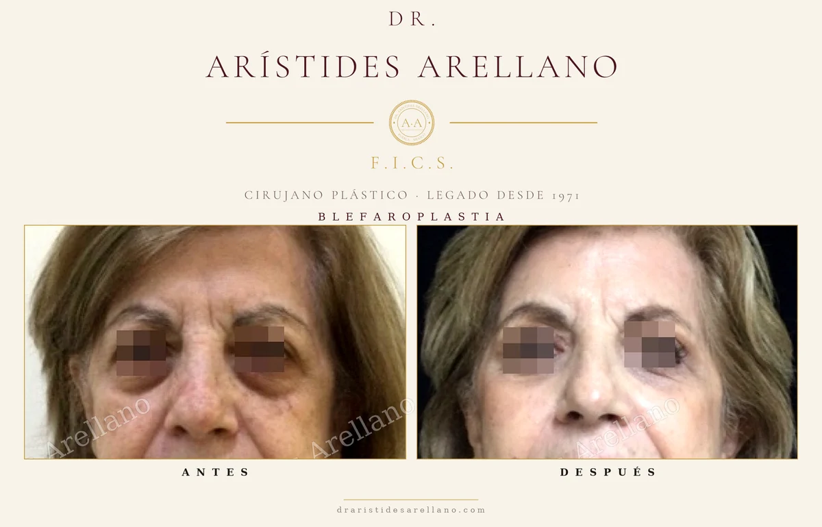 Blefaroplastia antes y después, vista frontal, corrección de asimetría entre un ojo y otro, cirugía de párpados del Dr. Arístides Arellano en Puebla