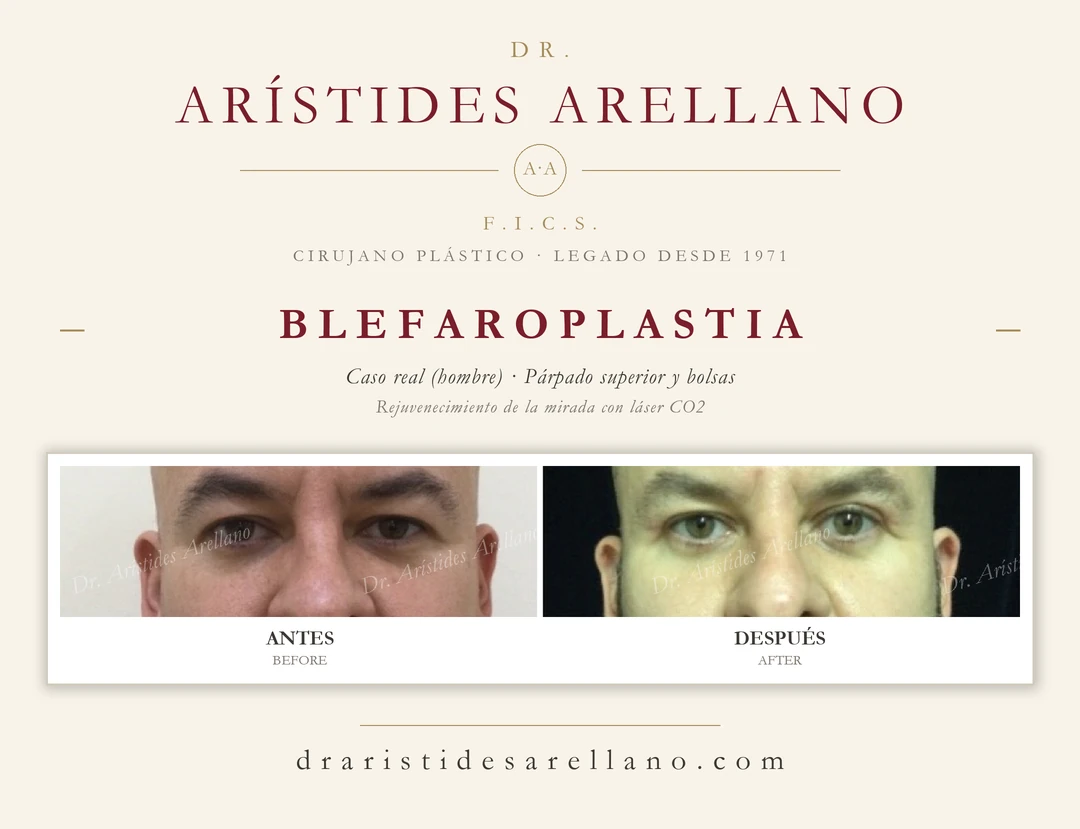 Blefaroplastia en hombre — antes y después en detalle de la mirada: corrección del exceso de piel del párpado superior y las bolsas, rejuvenecimiento periocular con láser CO2; caso real del Dr. Arístides Arellano en Puebla