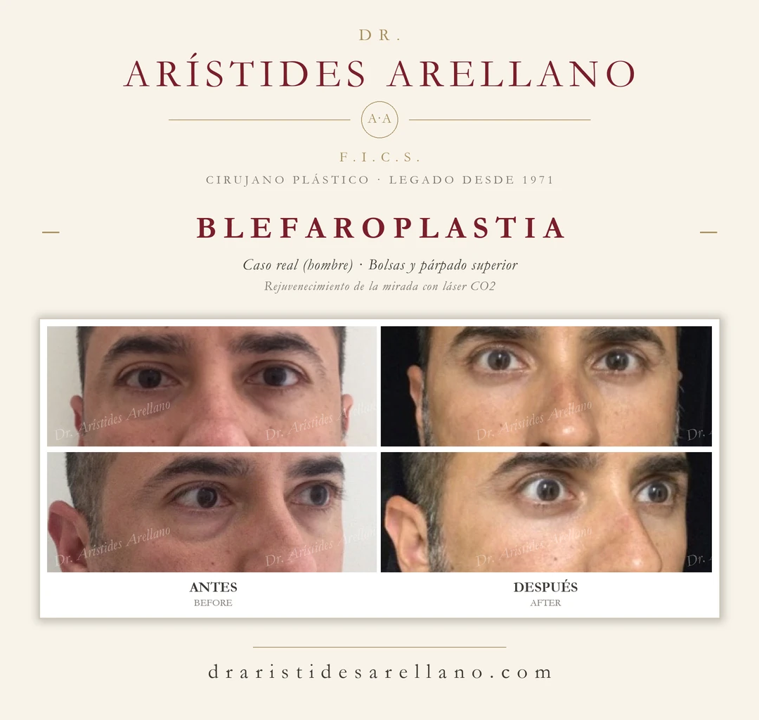 Blefaroplastia en hombre — antes y después de bolsas y párpado superior en dos ángulos (frontal y oblicua), rejuvenecimiento de la mirada con láser CO2; caso real del Dr. Arístides Arellano en Puebla