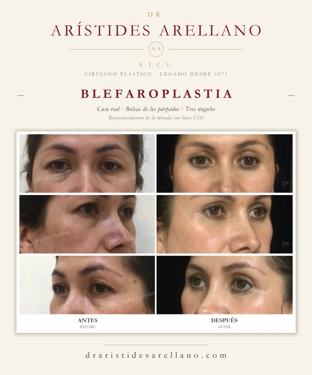 Blefaroplastia inferior — antes y después de las bolsas de los párpados en tres ángulos (frontal y oblicuas), rejuvenecimiento periocular con láser CO2; caso real del Dr. Arístides Arellano en Puebla