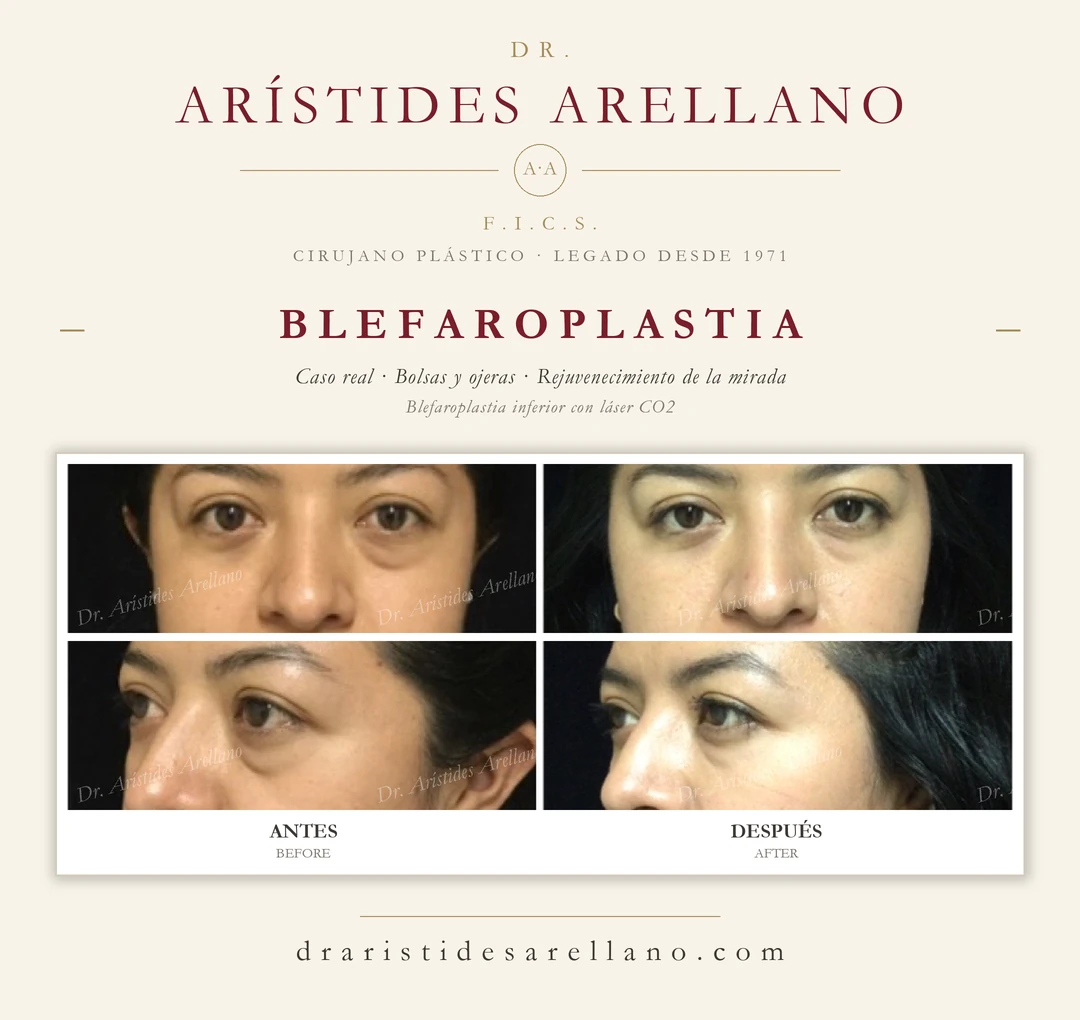 Blefaroplastia inferior — antes y después de bolsas y ojeras en dos ángulos (frontal y oblicua), rejuvenecimiento de la mirada con láser CO2; caso real del Dr. Arístides Arellano en Puebla