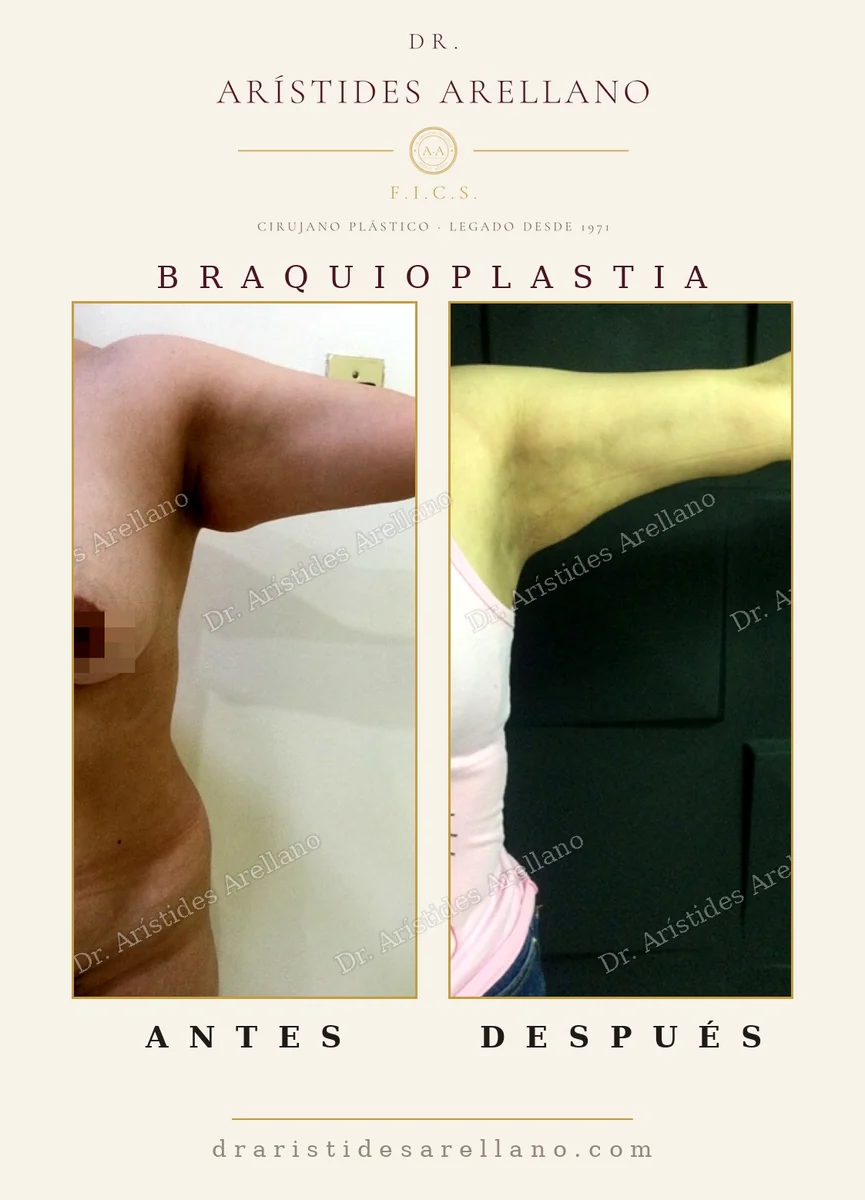 Brachioplasty (arm lift) before and after, removal of excess arm skin after weight loss, surgery by Dr. Arístides Arellano, plastic surgeon in Puebla