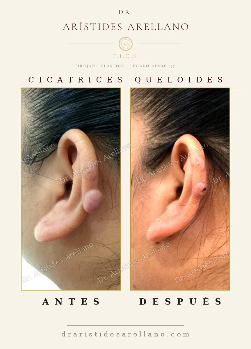 Earlobe keloid before and after excision, keloid scar from piercing, surgery by Dr. Arístides Arellano, plastic surgeon in Puebla