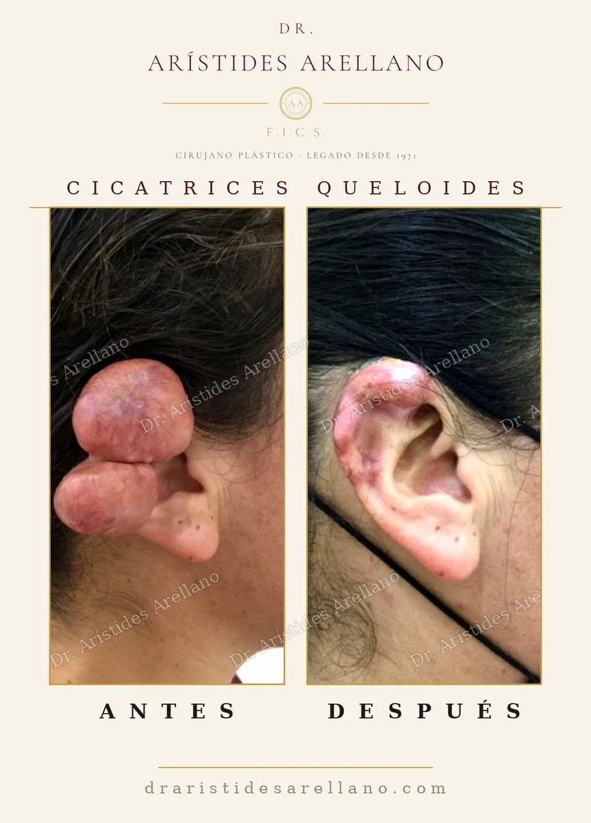 Large ear keloid excision before and after, earlobe reconstruction, real result by Dr. Arístides Arellano in Puebla