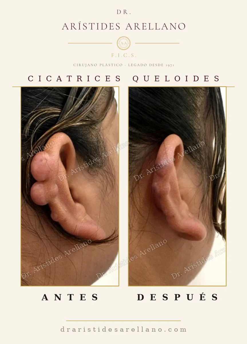 Multiple ear keloids before and after, surgical correction and follow-up, case by Dr. Arístides Arellano, plastic surgeon in Puebla