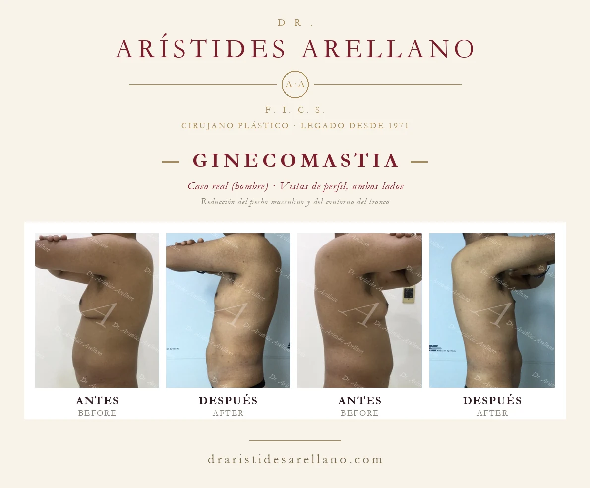 Ginecomastia — antes y después en vistas de perfil, ambos lados, reducción del pecho masculino, caso real del Dr. Arístides Arellano, cirujano plástico en Puebla
