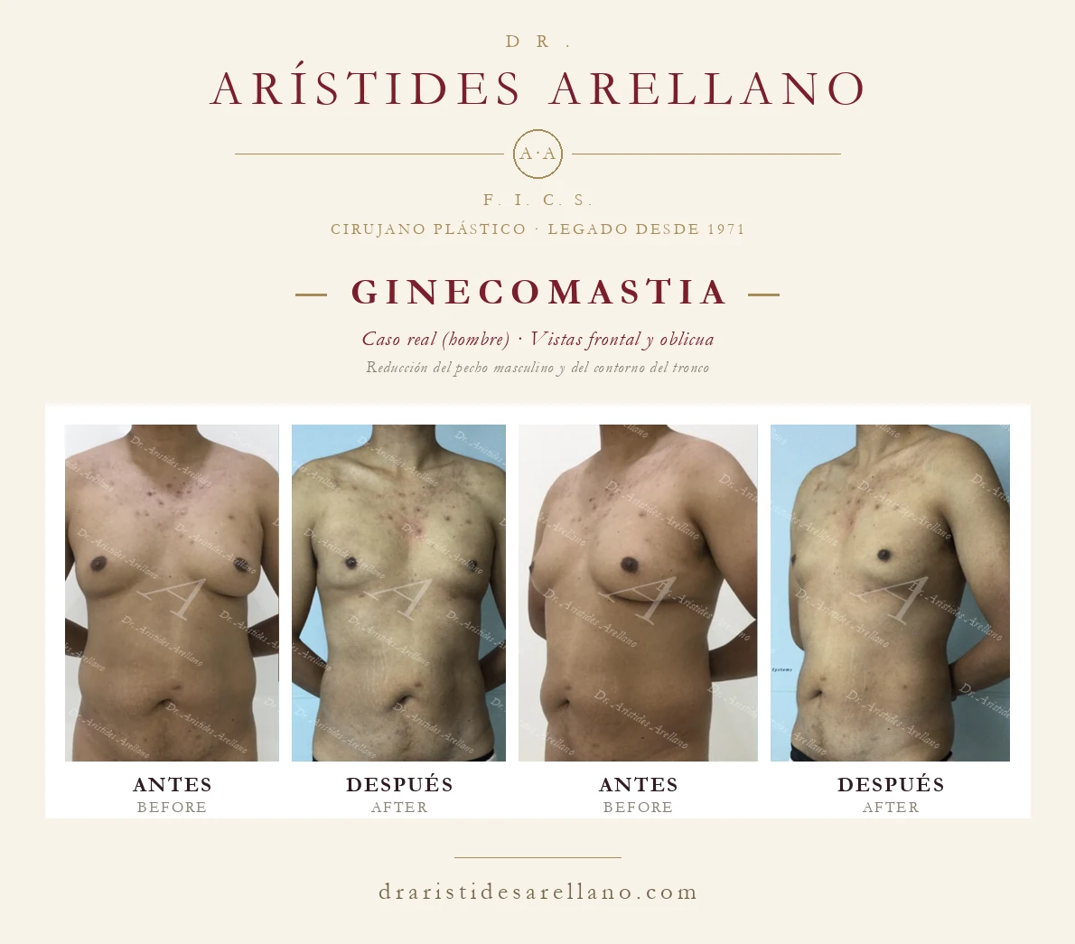 Ginecomastia — antes y después en vistas frontal y oblicua, reducción del pecho masculino, caso real del Dr. Arístides Arellano, cirujano plástico en Puebla
