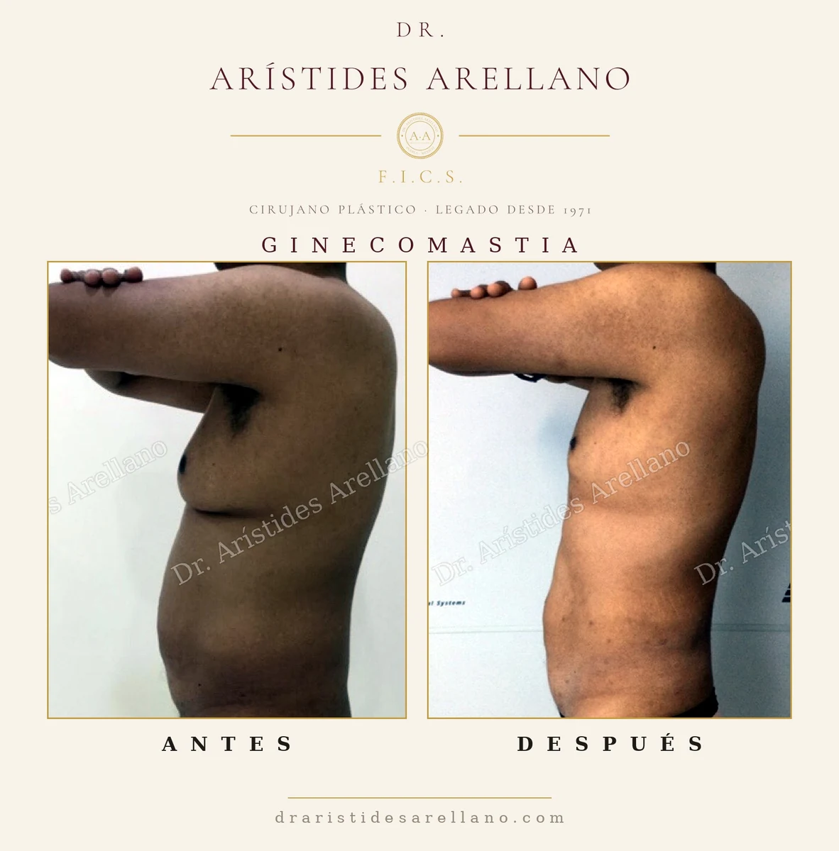 Ginecomastia en hombre, vista de perfil: tórax plano y firme — antes y después, cirugía del Dr. Arístides Arellano en Puebla