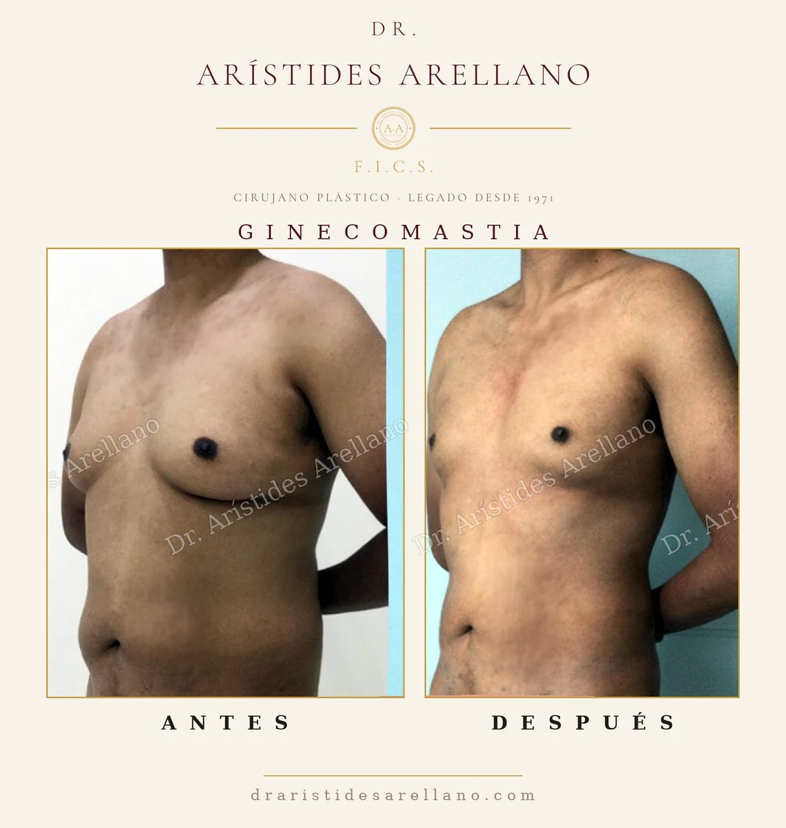 Ginecomastia, vista frontal: corrección del exceso de tejido mamario masculino — antes y después con el Dr. Arístides Arellano en Puebla
