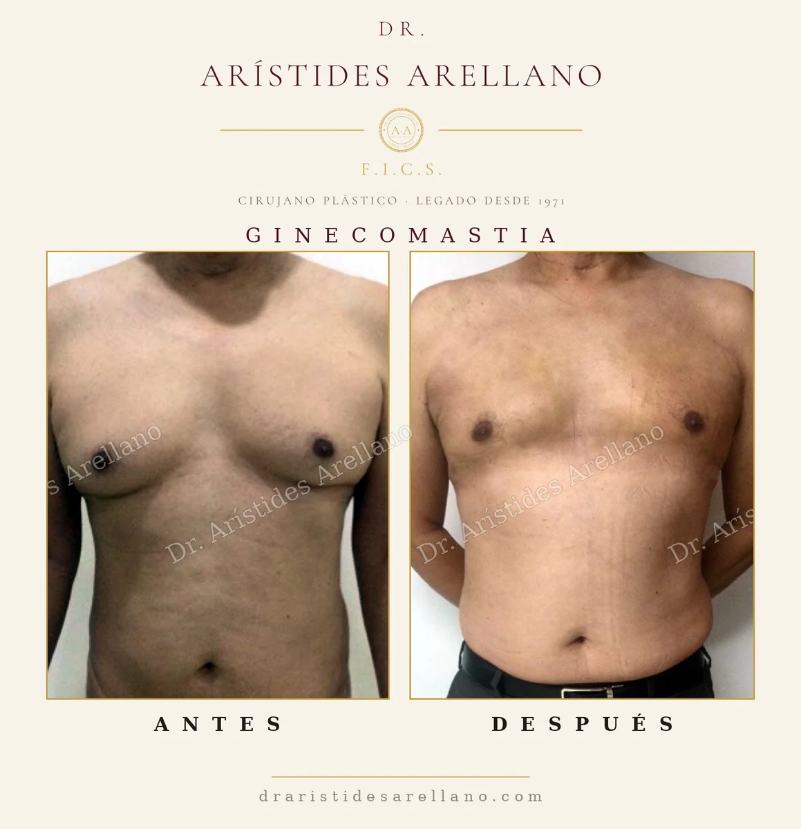 Ginecomastia — antes y después en vista frontal, reducción del pecho masculino, caso real del Dr. Arístides Arellano, cirujano plástico en Puebla