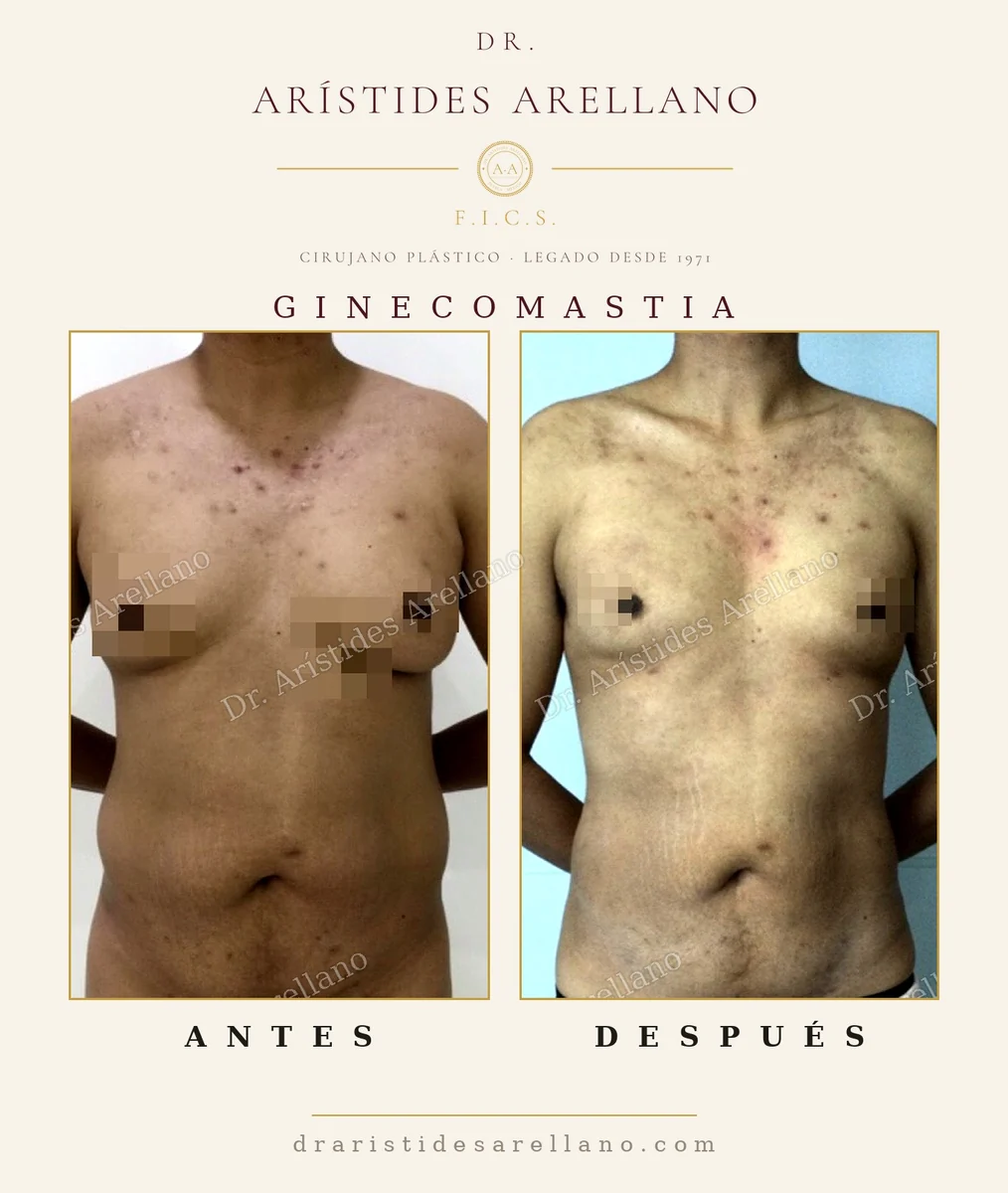 Ginecomastia antes y después en vista frontal, reducción del pecho masculino en paciente delgado, cirugía del Dr. Arístides Arellano, cirujano plástico en Puebla