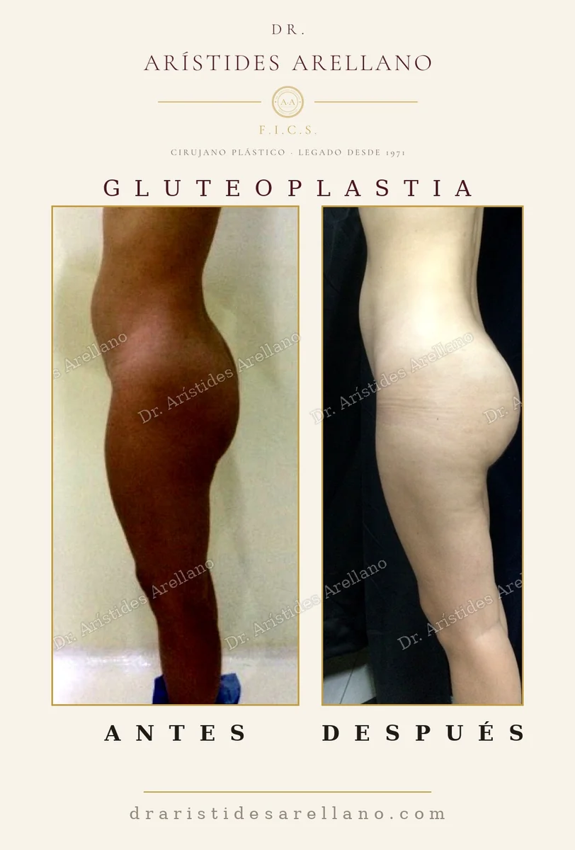 Gluteal implant surgery before and after in profile, buttock augmentation with a solid silicone implant, surgery by Dr. Arístides Arellano in Puebla