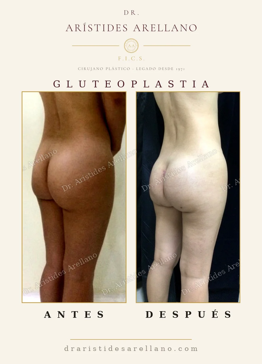 Buttock implant augmentation before and after, back view, result in a slim patient with no donor fat, case by Dr. Arístides Arellano, plastic surgeon in Puebla