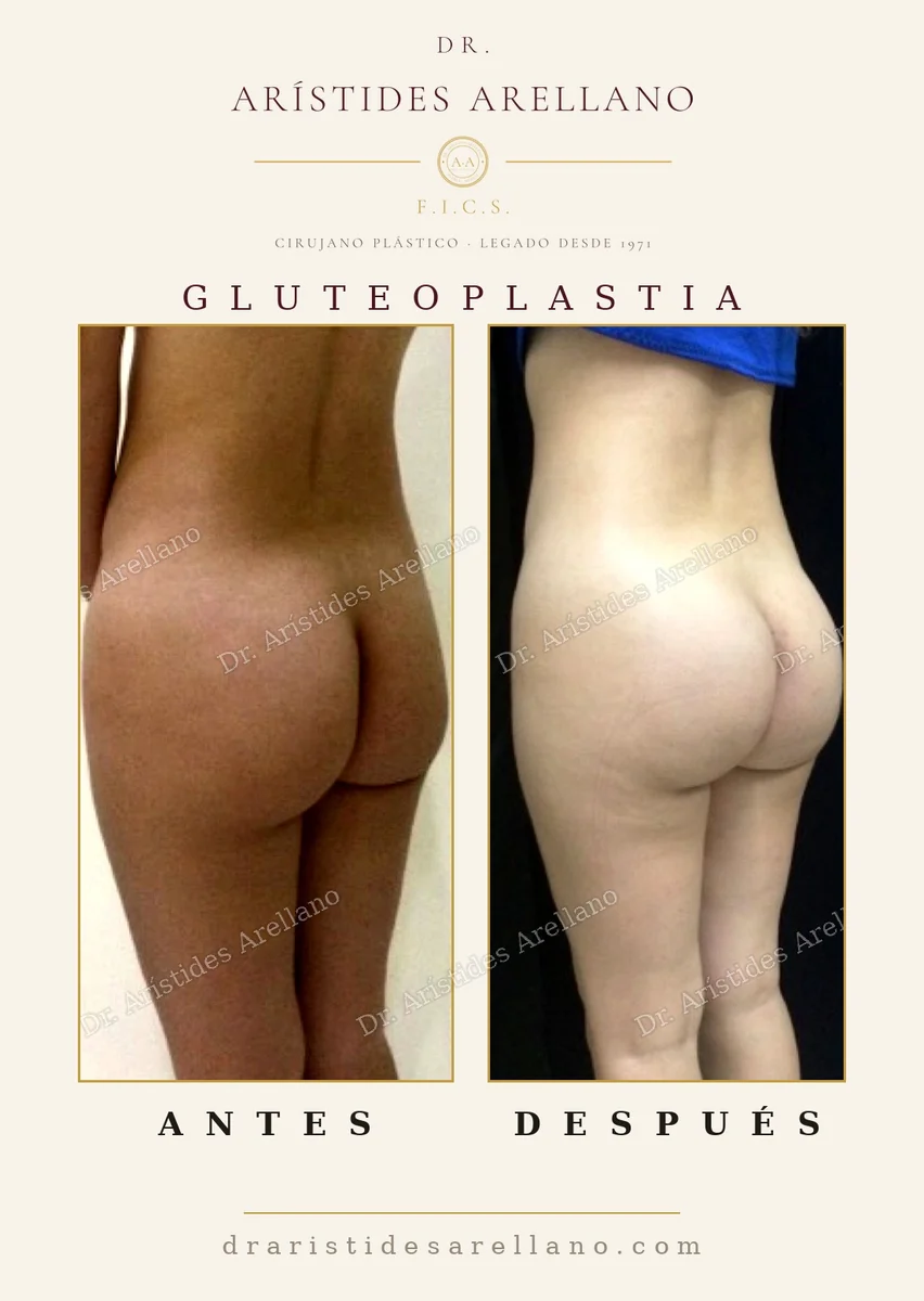Gluteal implant before and after, intramuscular placement and scar hidden in the intergluteal crease, result by Dr. Arístides Arellano in Puebla