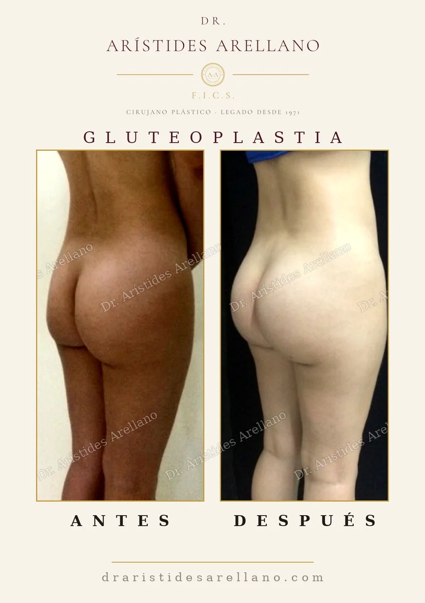 Buttock augmentation with prosthesis before and after, stable long-term projection, surgery by Dr. Arístides Arellano, plastic surgeon in Puebla