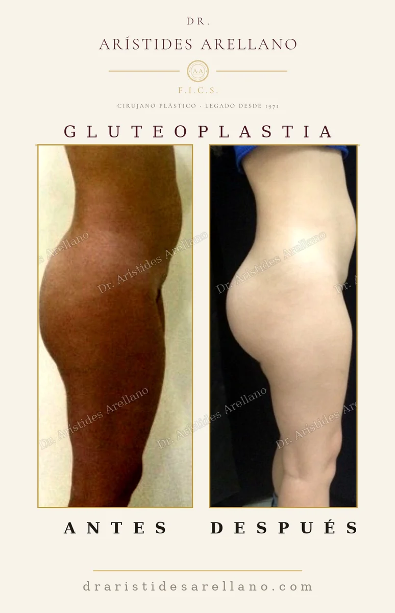 Gluteal implant before and after in profile, recovery timeline after buttock implant surgery, real case by Dr. Arístides Arellano in Puebla