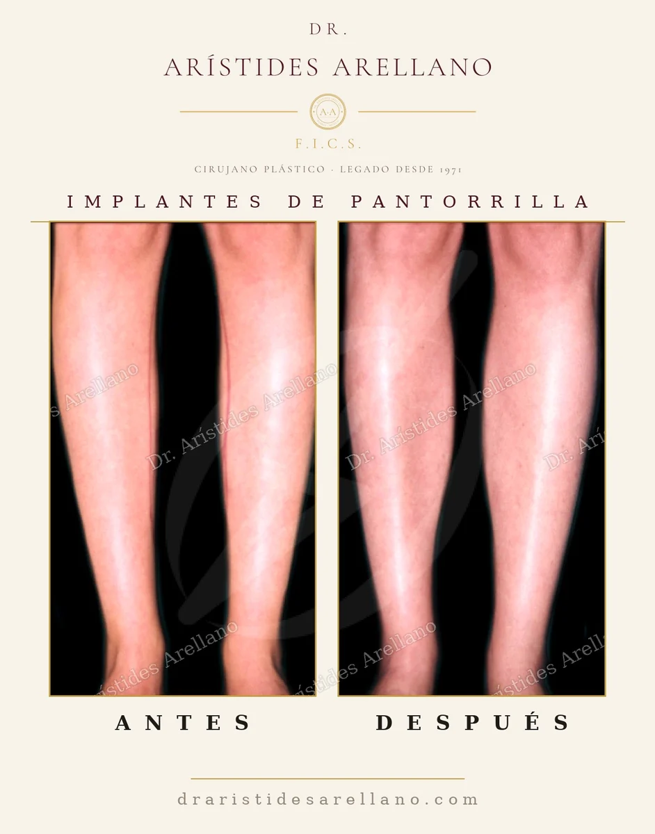 Calf implant before and after, leg volume augmentation with a solid silicone implant, surgery by Dr. Arístides Arellano in Puebla
