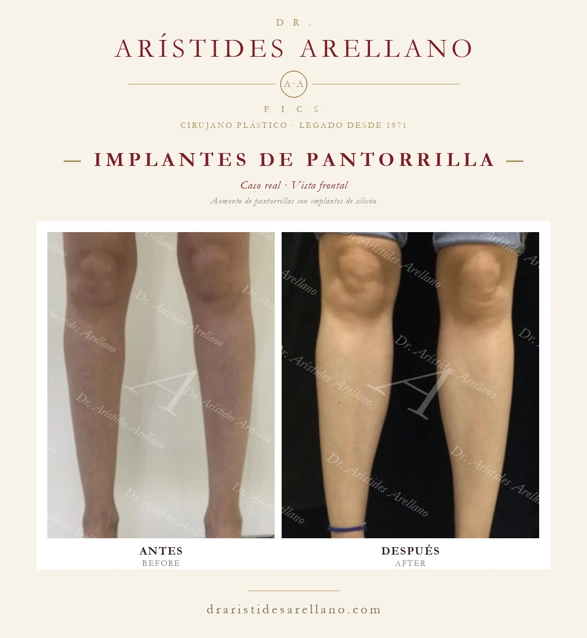Calf implants — frontal before and after, calf augmentation with silicone implants, real case by Dr. Arístides Arellano in Puebla