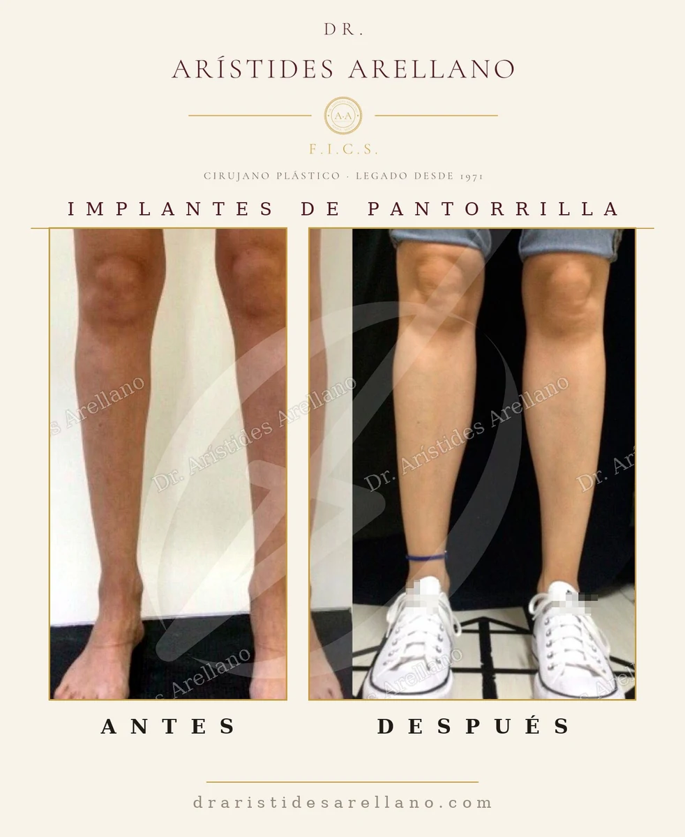 Calf implants: leg contour before and after — surgery by Dr. Arístides Arellano, plastic surgeon in Puebla, México