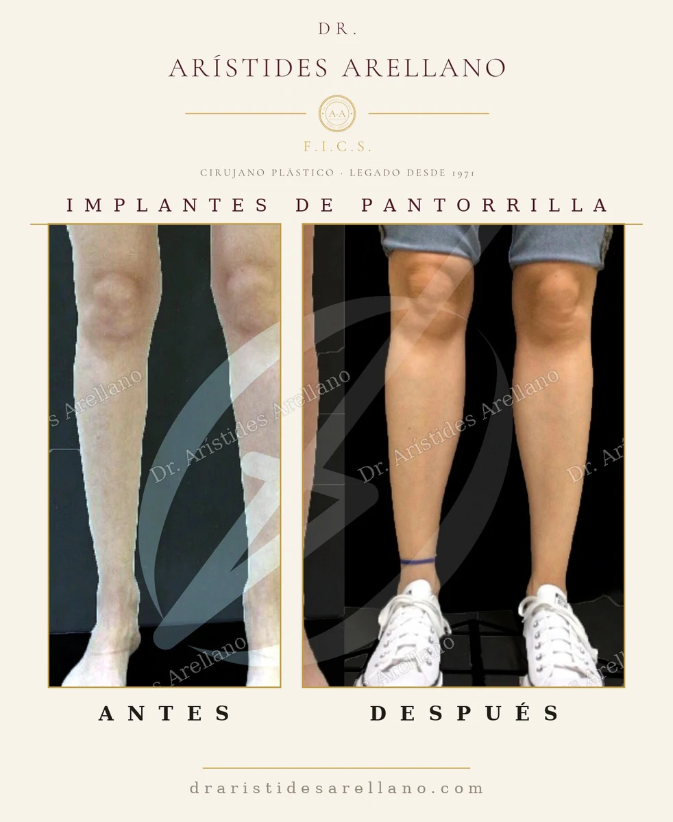 Calf implants, second case: leg volume and proportion — before-and-after with Dr. Arístides Arellano in Puebla