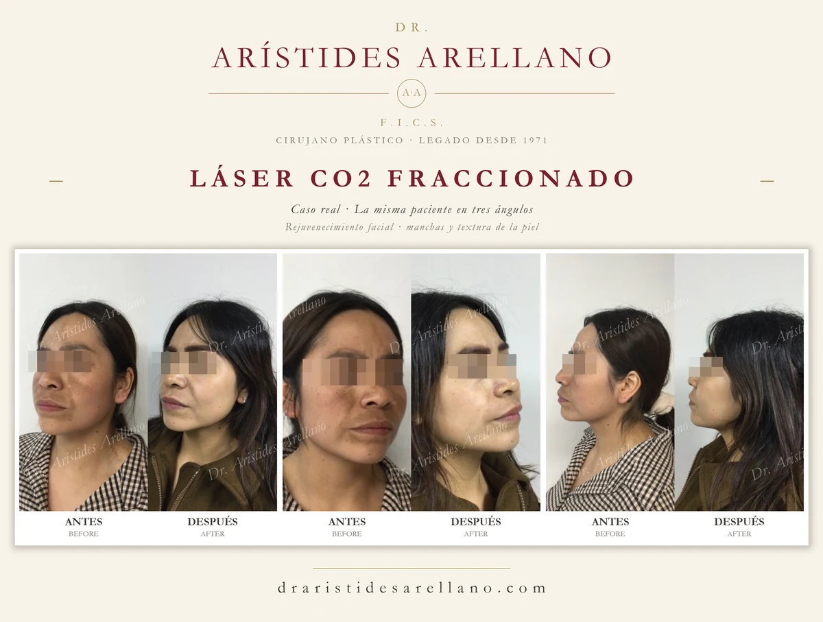 Láser CO2 fraccionado — antes y después de la misma paciente en tres ángulos, rejuvenecimiento facial con mejoría de manchas y textura, caso real del Dr. Arístides Arellano en Puebla