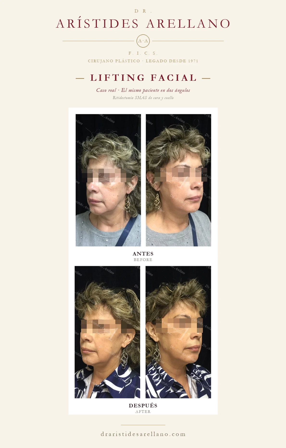 Lifting facial (ritidectomía SMAS) en Puebla — el mismo paciente en dos ángulos, antes y después con el Dr. Arístides Arellano