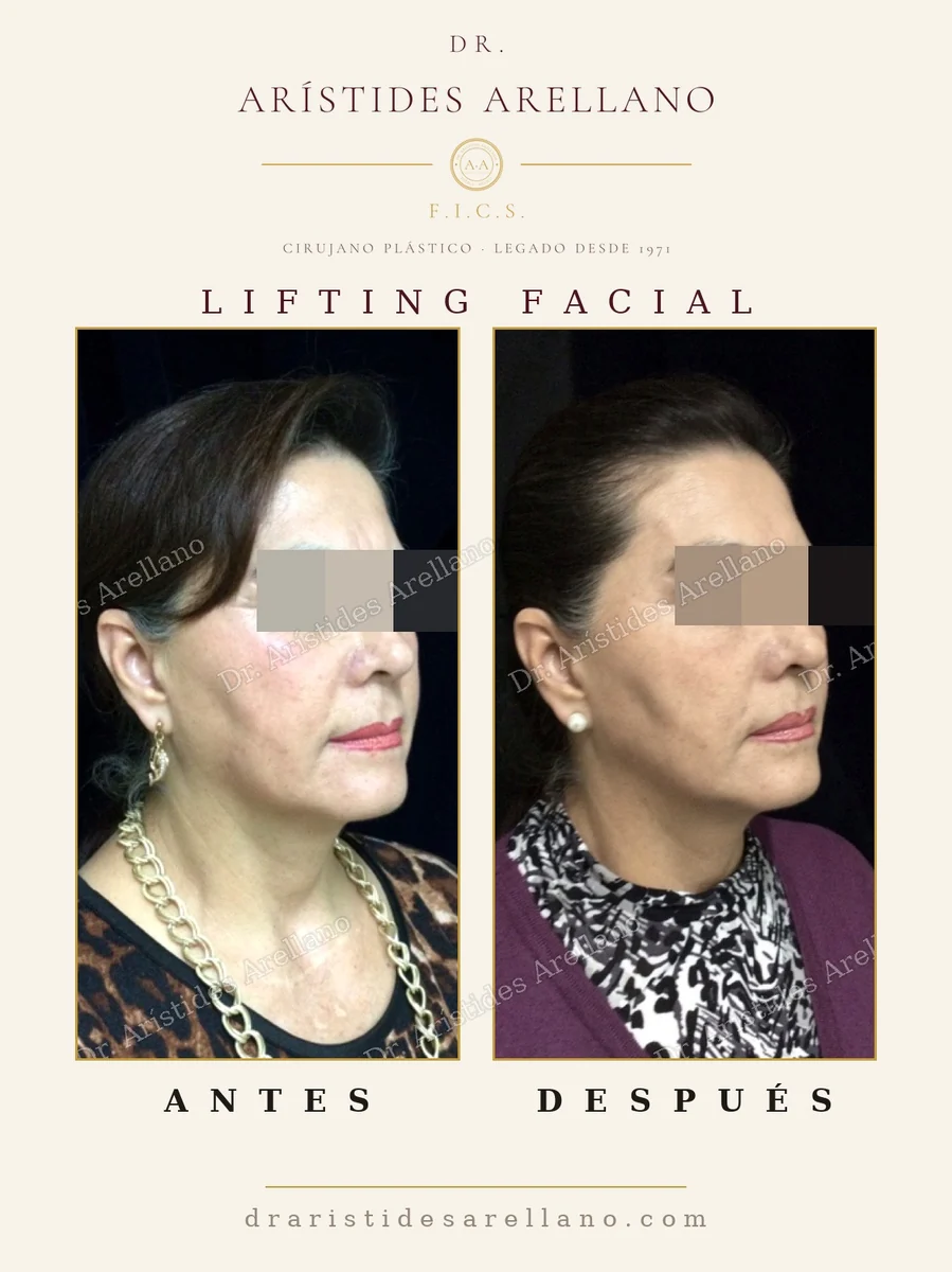 Lifting facial antes y después, duración del resultado a largo plazo, resultado real del Dr. Arístides Arellano, cirujano plástico en Puebla