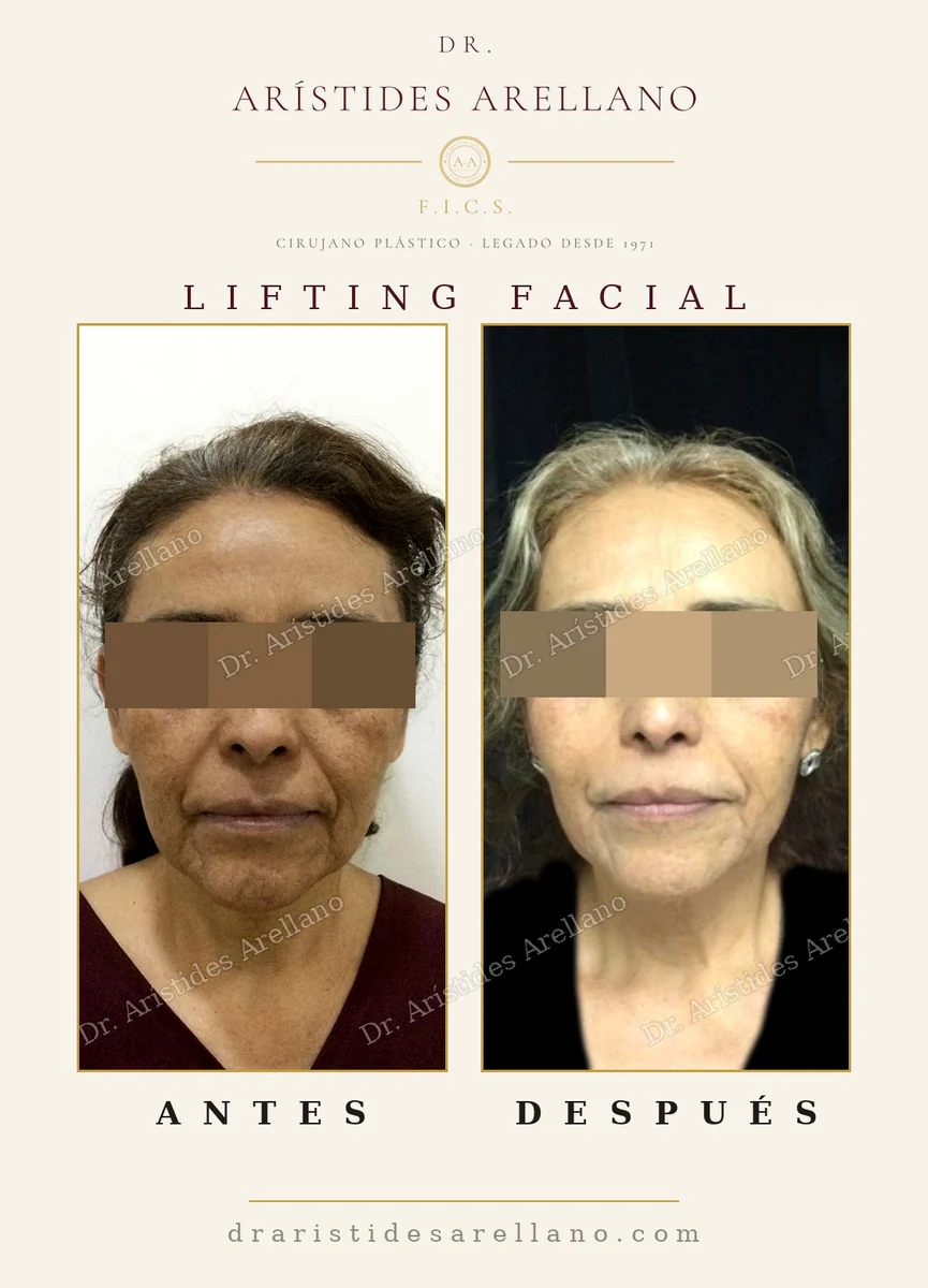 Lifting facial y de cuello antes y después, corrección del ángulo cervical y las bandas del cuello, cirugía del Dr. Arístides Arellano en Puebla