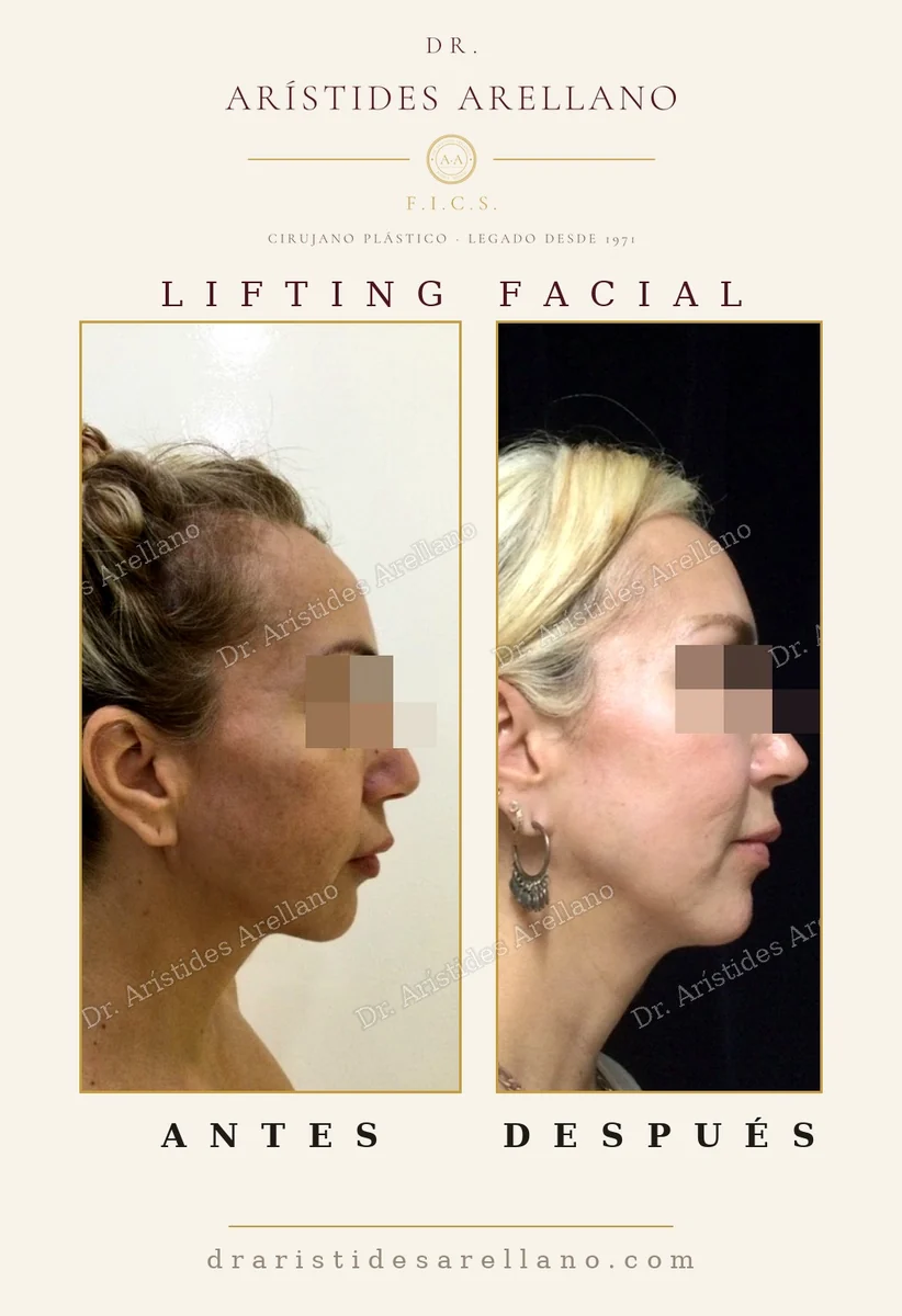 Lifting facial antes y después con resultado natural, sin aspecto estirado, caso real del Dr. Arístides Arellano, cirujano plástico en Puebla