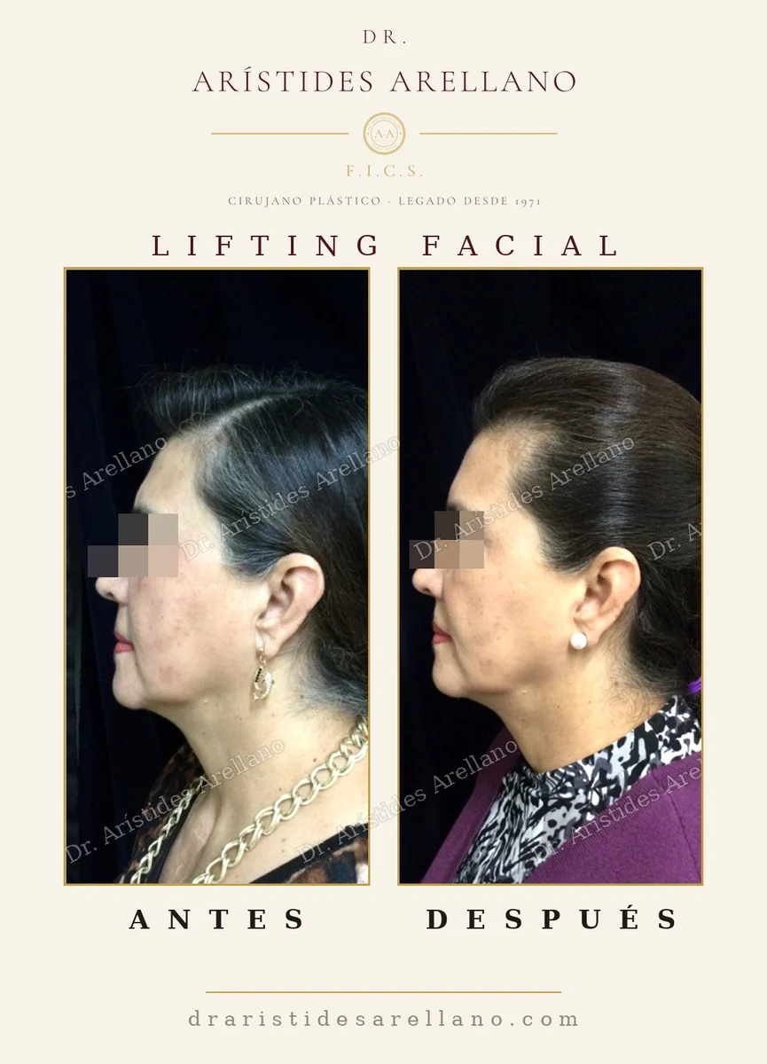 Lifting facial antes y después, evolución de la recuperación tras la ritidectomía, resultado del Dr. Arístides Arellano en Puebla