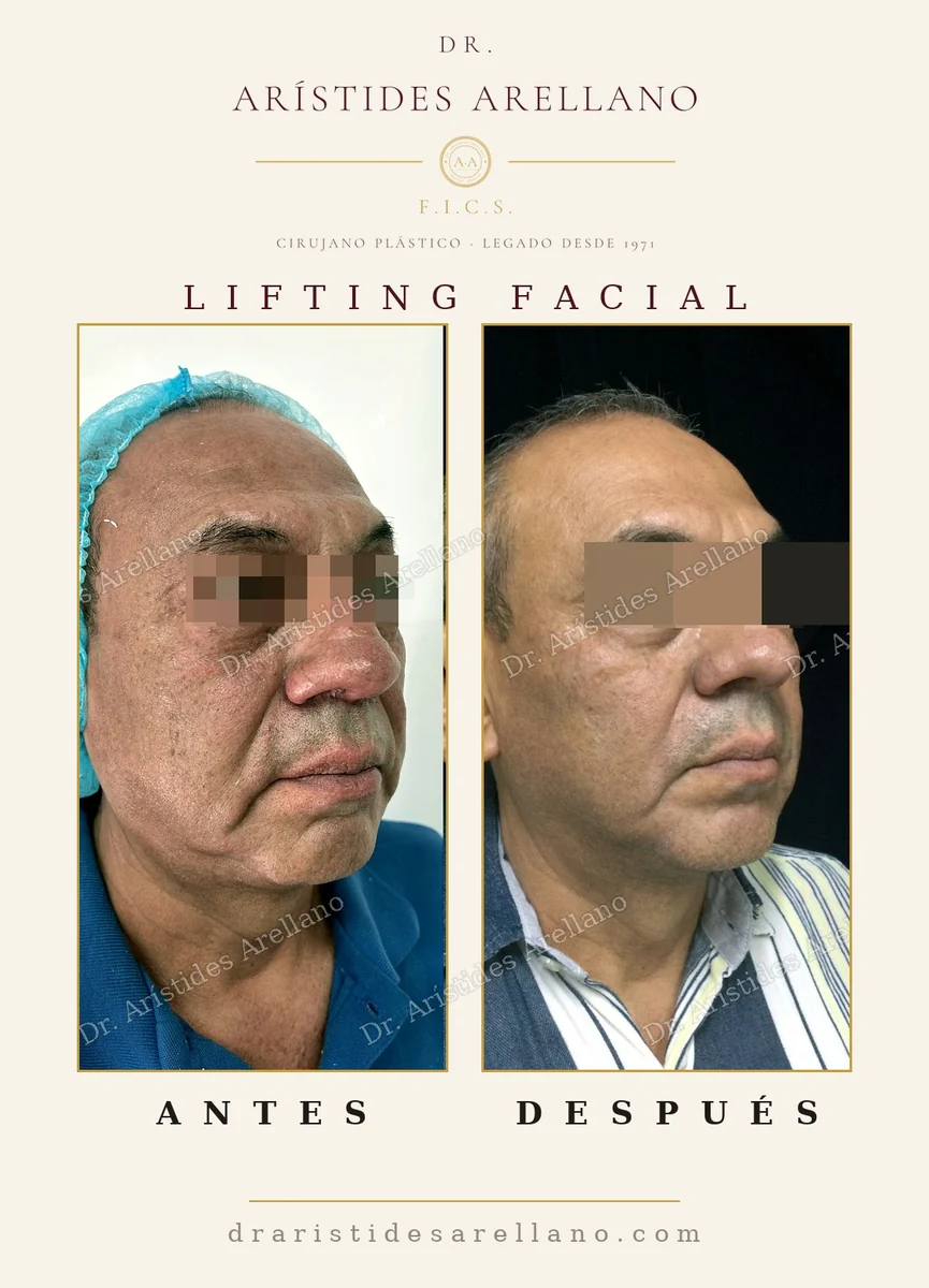 Lifting facial en hombre antes y después, reposición del tercio inferior y del cuello, resultado del Dr. Arístides Arellano, cirujano plástico en Puebla