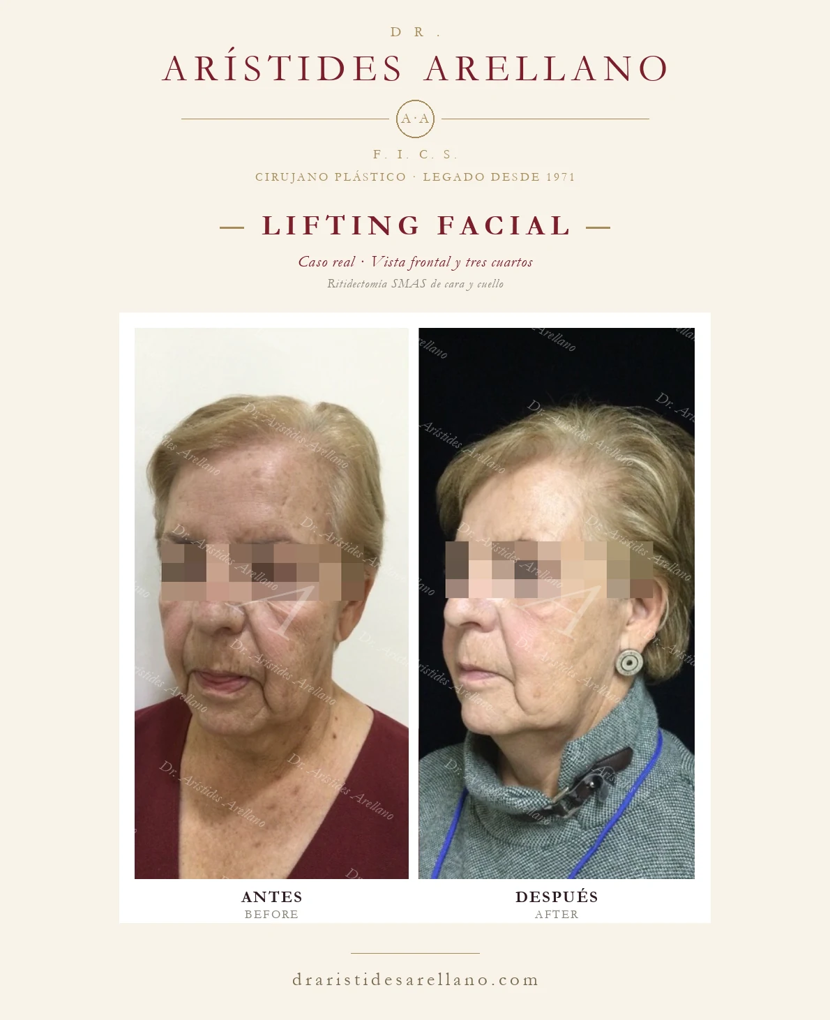 Lifting facial (ritidectomía SMAS) en Puebla — vista frontal y tres cuartos, antes y después con el Dr. Arístides Arellano