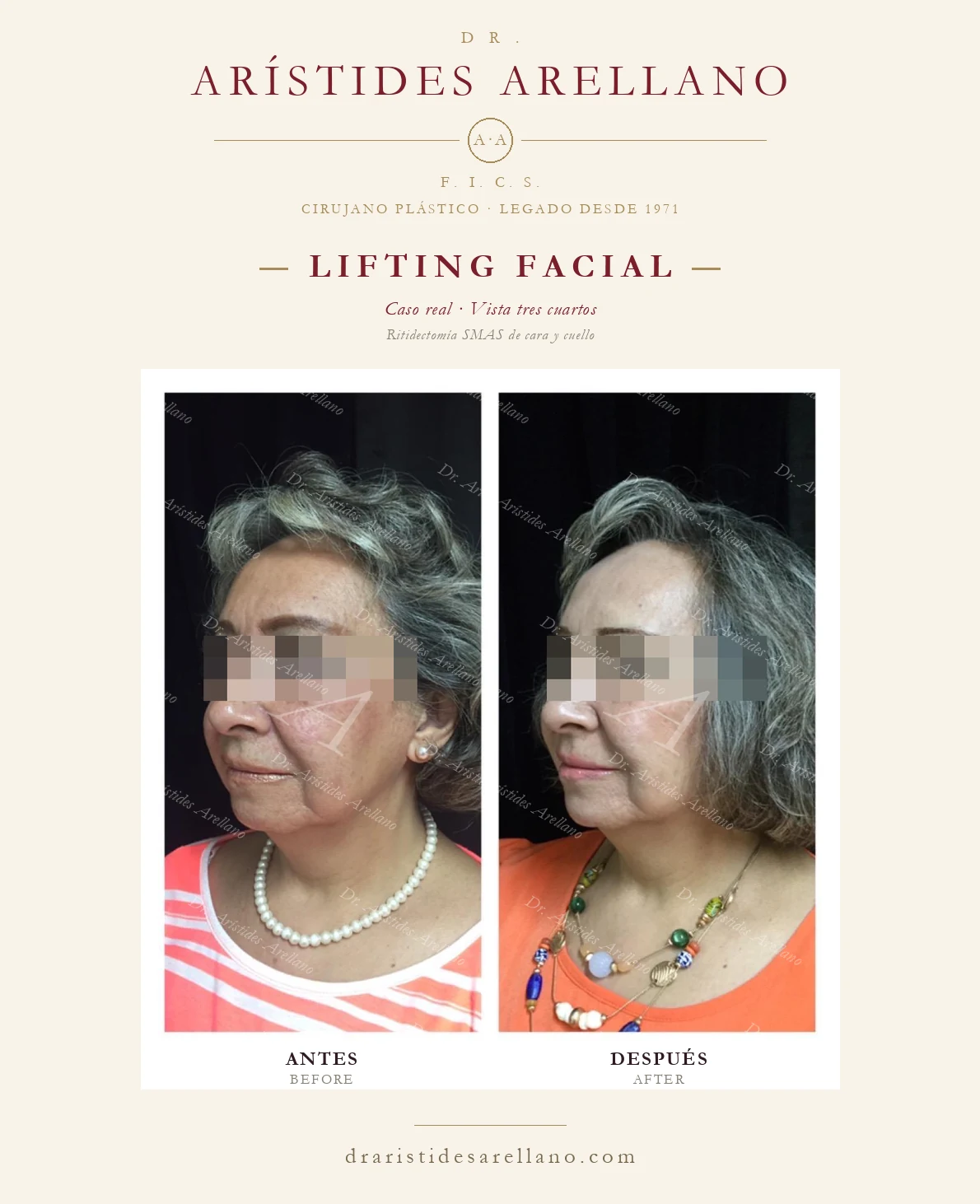 Lifting facial (ritidectomía SMAS) en Puebla — vista tres cuartos, antes y después con el Dr. Arístides Arellano