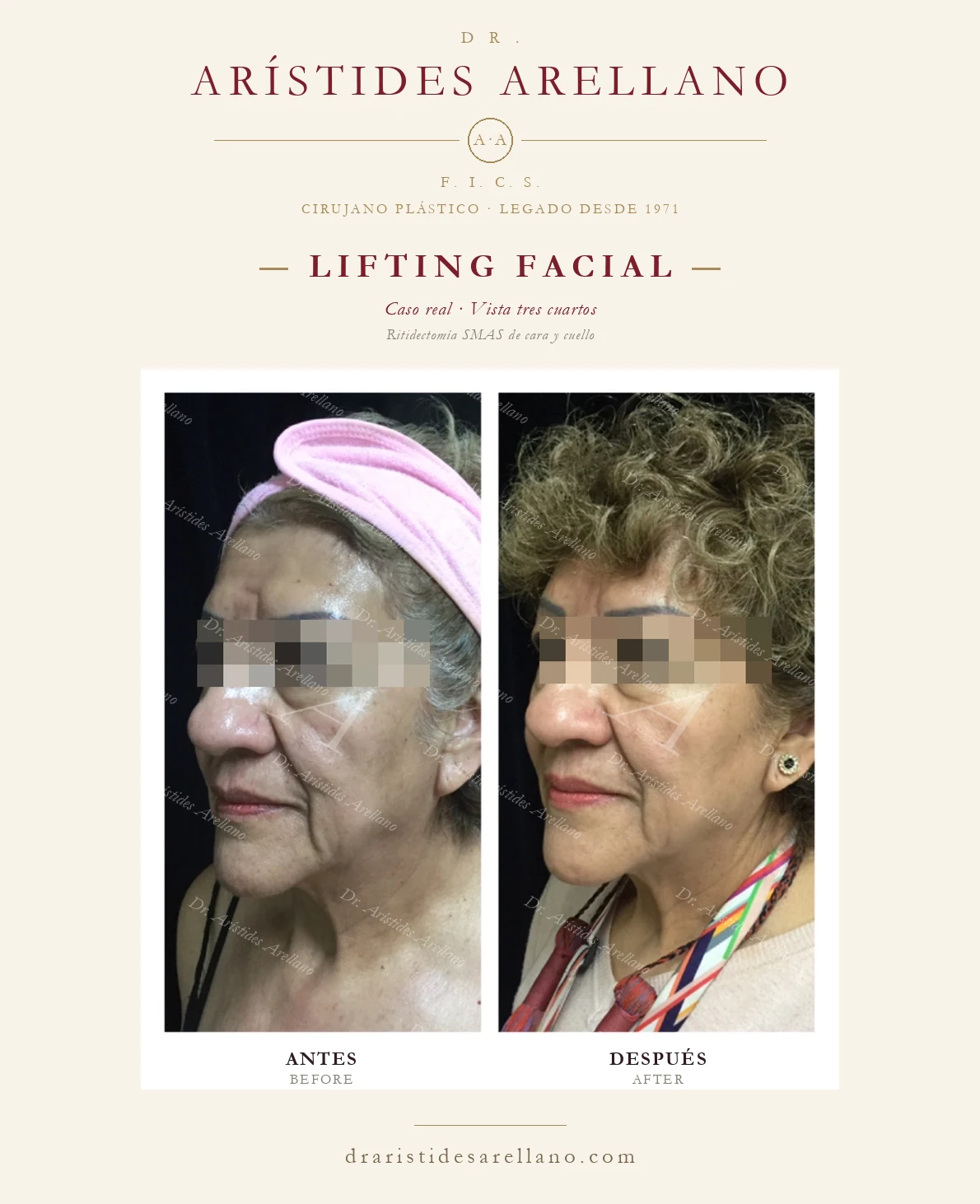 Lifting facial (ritidectomía SMAS) en Puebla — vista tres cuartos, antes y después con el Dr. Arístides Arellano