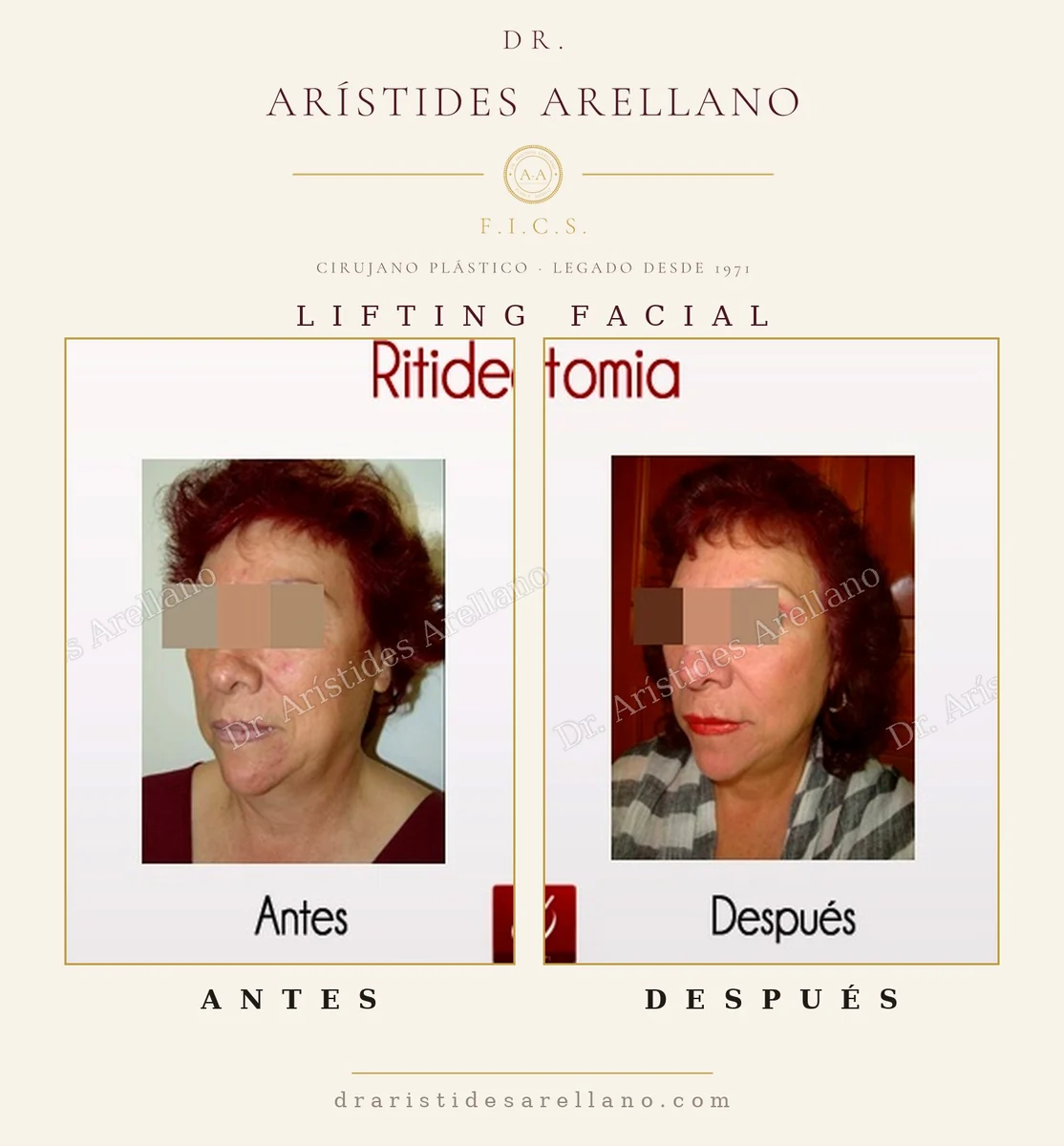 Lifting facial (ritidectomía) antes y después, reposición del tercio medio e inferior de la cara, cirugía del Dr. Arístides Arellano, cirujano plástico en Puebla
