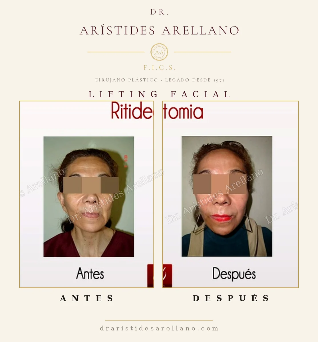 Lifting facial antes y después, definición del óvalo facial y la mandíbula, caso real del Dr. Arístides Arellano en Puebla