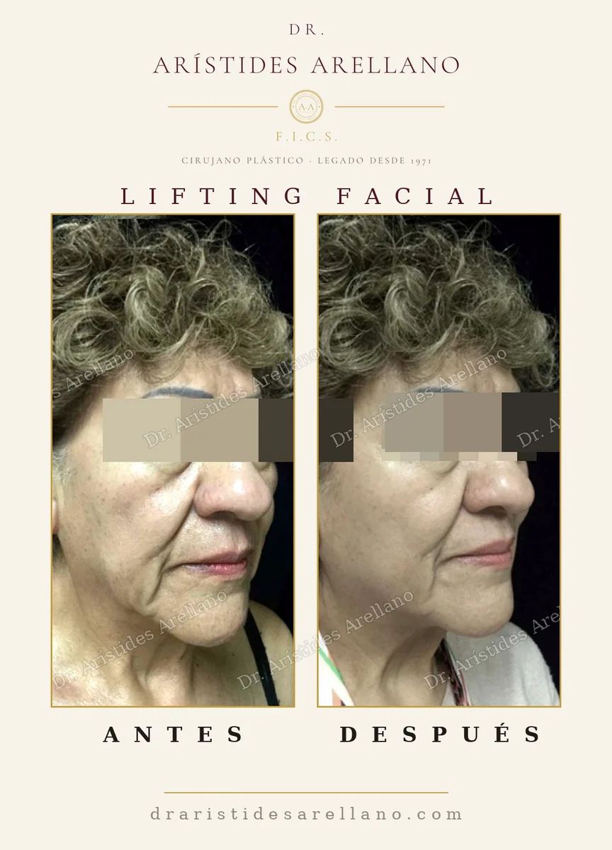 Lifting facial antes y después comparado con tratamientos no quirúrgicos, reposición real de tejidos, cirugía del Dr. Arístides Arellano en Puebla