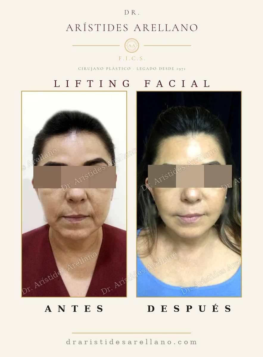 Lifting facial antes y después, momento adecuado para operarse según el grado de descolgamiento, caso del Dr. Arístides Arellano, cirujano plástico en Puebla