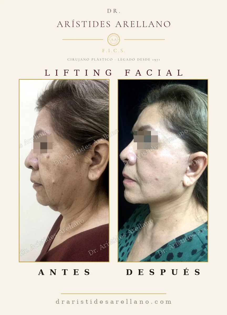 Lifting facial antes y después en vista de perfil, ubicación de las cicatrices alrededor de la oreja, cirugía del Dr. Arístides Arellano en Puebla
