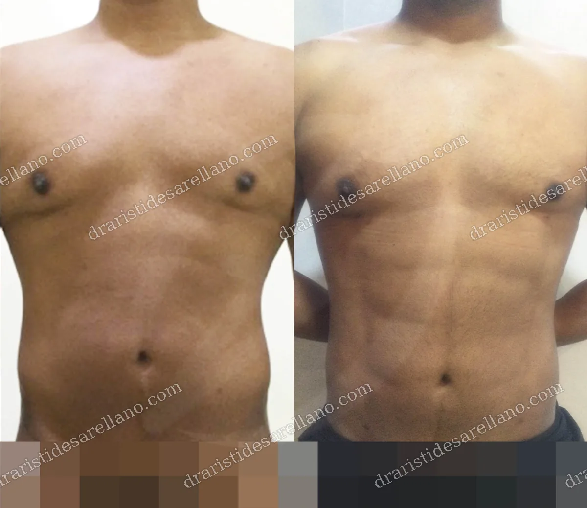 Lipoescultura HD con lipomarcaje (marcación abdominal en hombre) — antes y después, resultado real del Dr. Arístides Arellano, cirujano plástico en Puebla