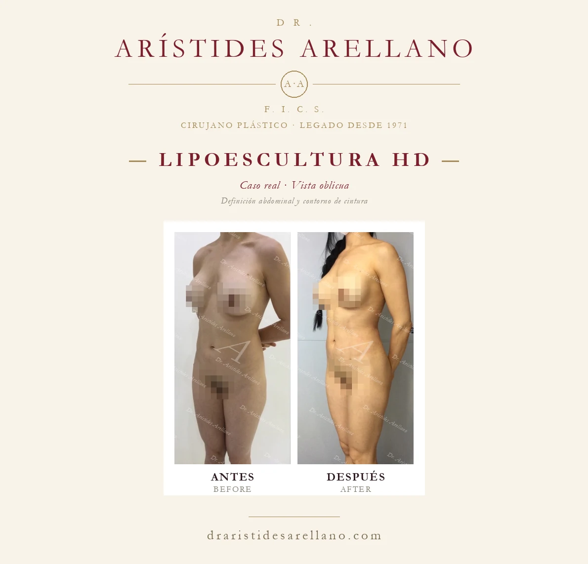 Lipoescultura HD y aumento mamario — antes y después en vista oblicua, definición abdominal y contorno de cintura, caso real del Dr. Arístides Arellano en Puebla