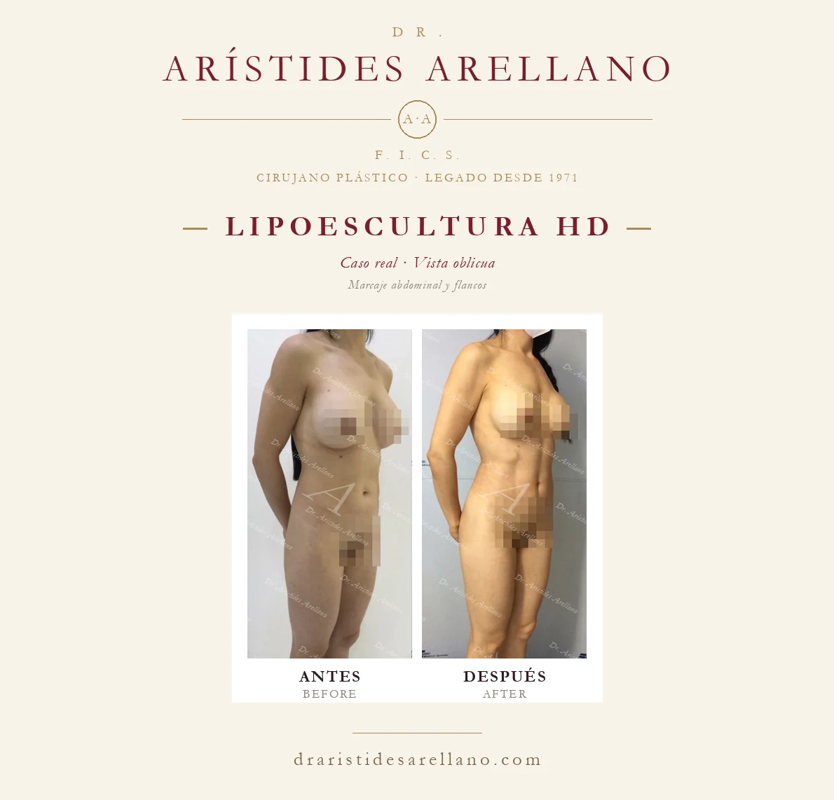 Lipoescultura HD y aumento mamario — antes y después en vista oblicua, marcaje abdominal y flancos, caso real del Dr. Arístides Arellano en Puebla
