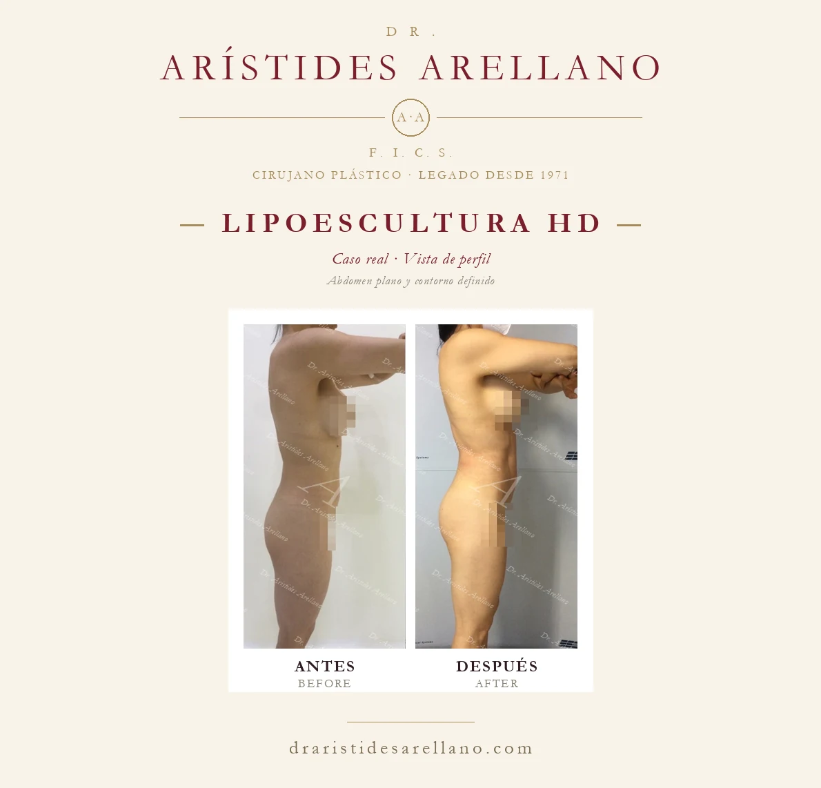 Lipoescultura HD — antes y después de perfil, abdomen plano y contorno definido, caso real del Dr. Arístides Arellano en Puebla