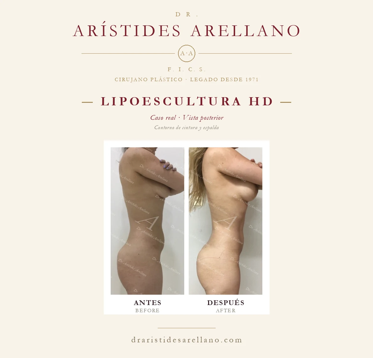 Lipoescultura HD — antes y después en vista posterior, contorno de cintura y espalda, caso real del Dr. Arístides Arellano en Puebla