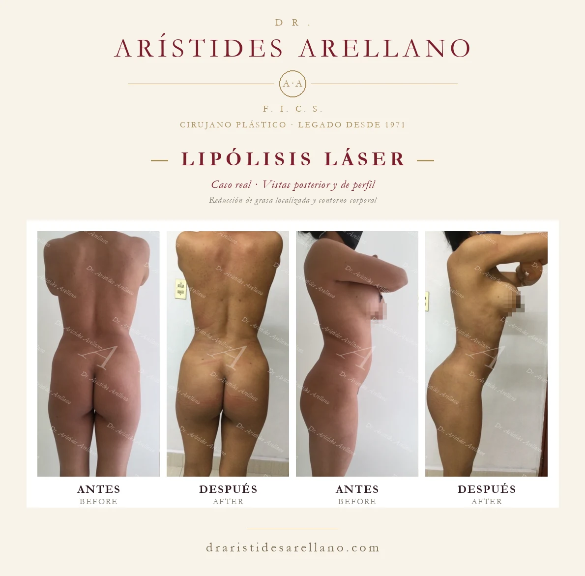 Laser lipolysis — posterior and profile before and after, localized fat reduction and body contouring, real case by Dr. Arístides Arellano in Puebla
