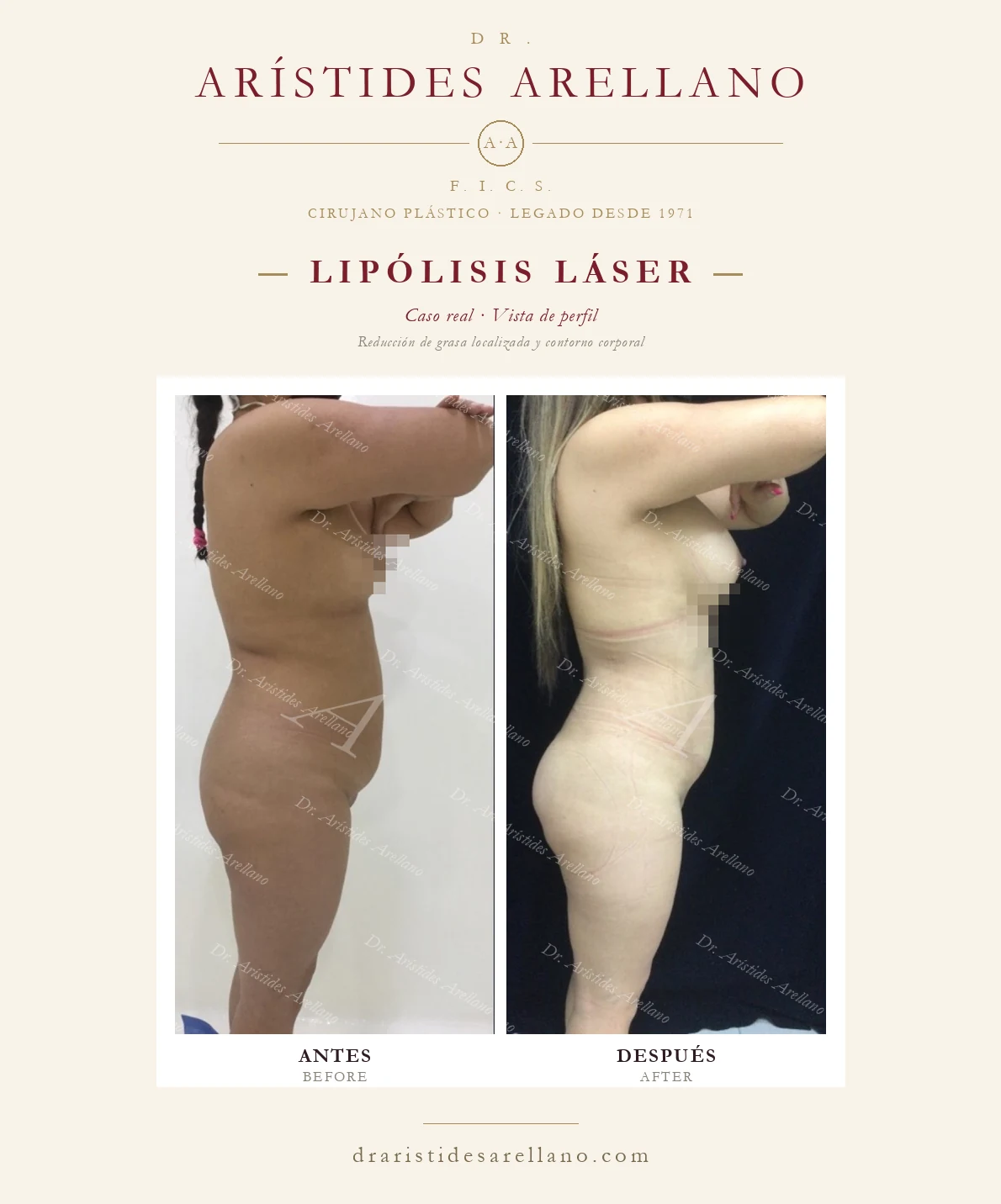 Laser lipolysis — profile before and after, localized fat reduction and body contouring, real case by Dr. Arístides Arellano in Puebla