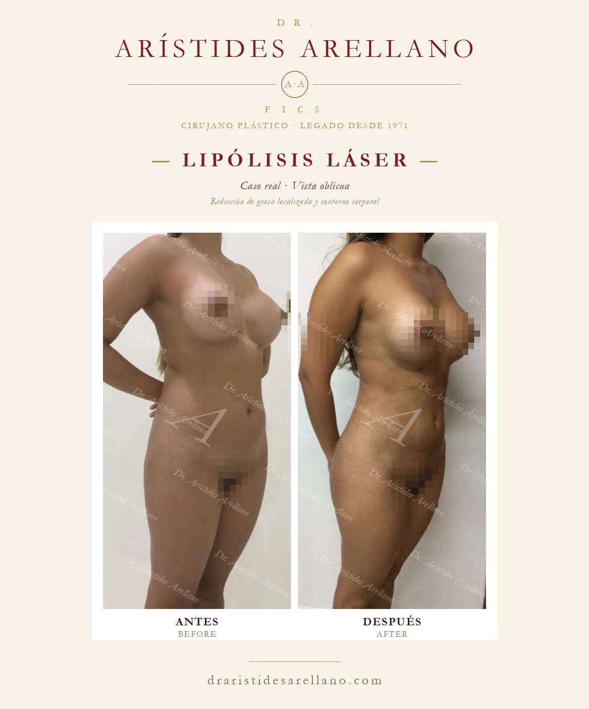 Laser lipolysis — oblique before and after, localized fat reduction and body contouring, real case by Dr. Arístides Arellano in Puebla