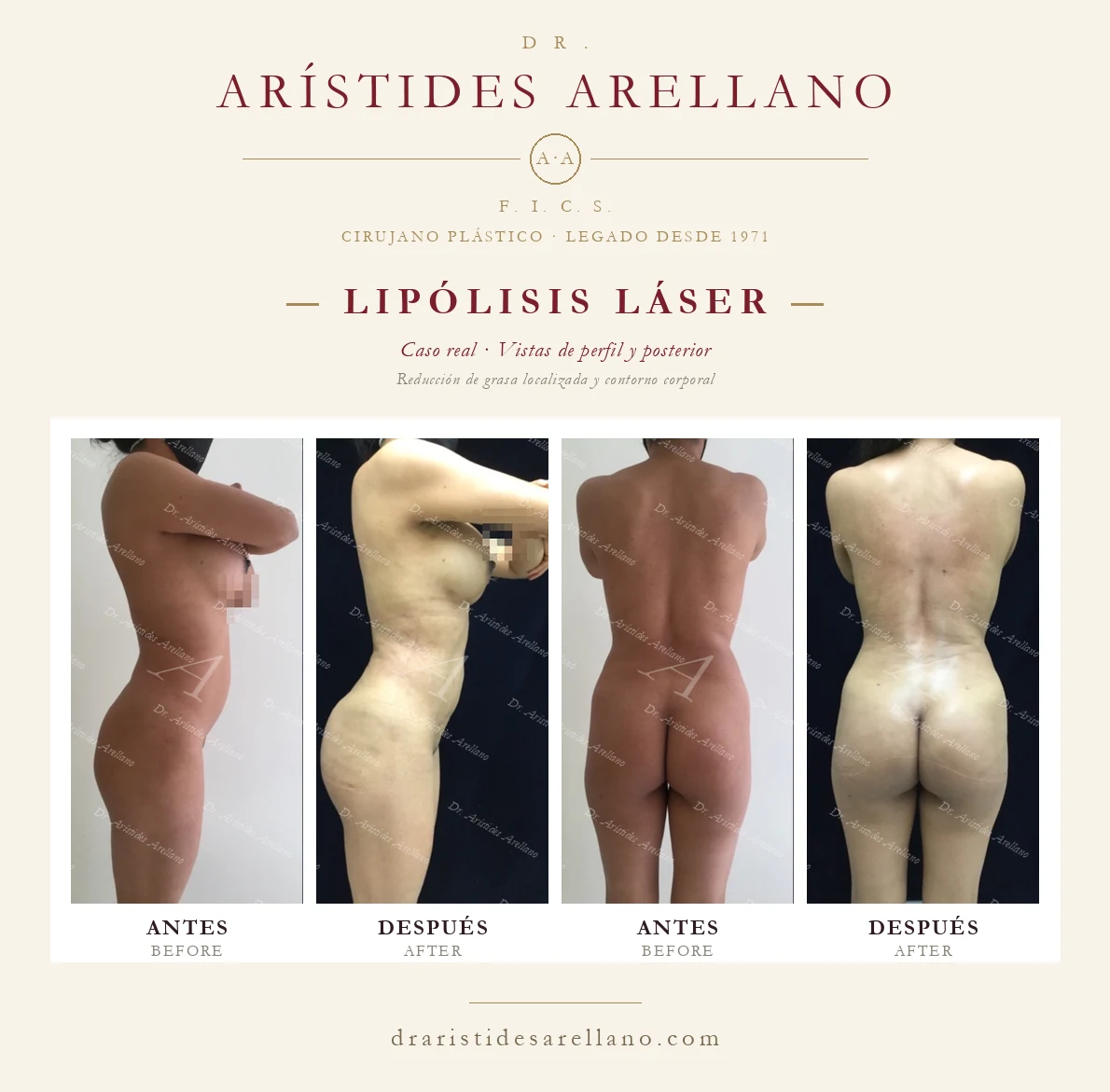 Laser lipolysis — profile and posterior before and after, localized fat reduction and body contouring, real case by Dr. Arístides Arellano in Puebla