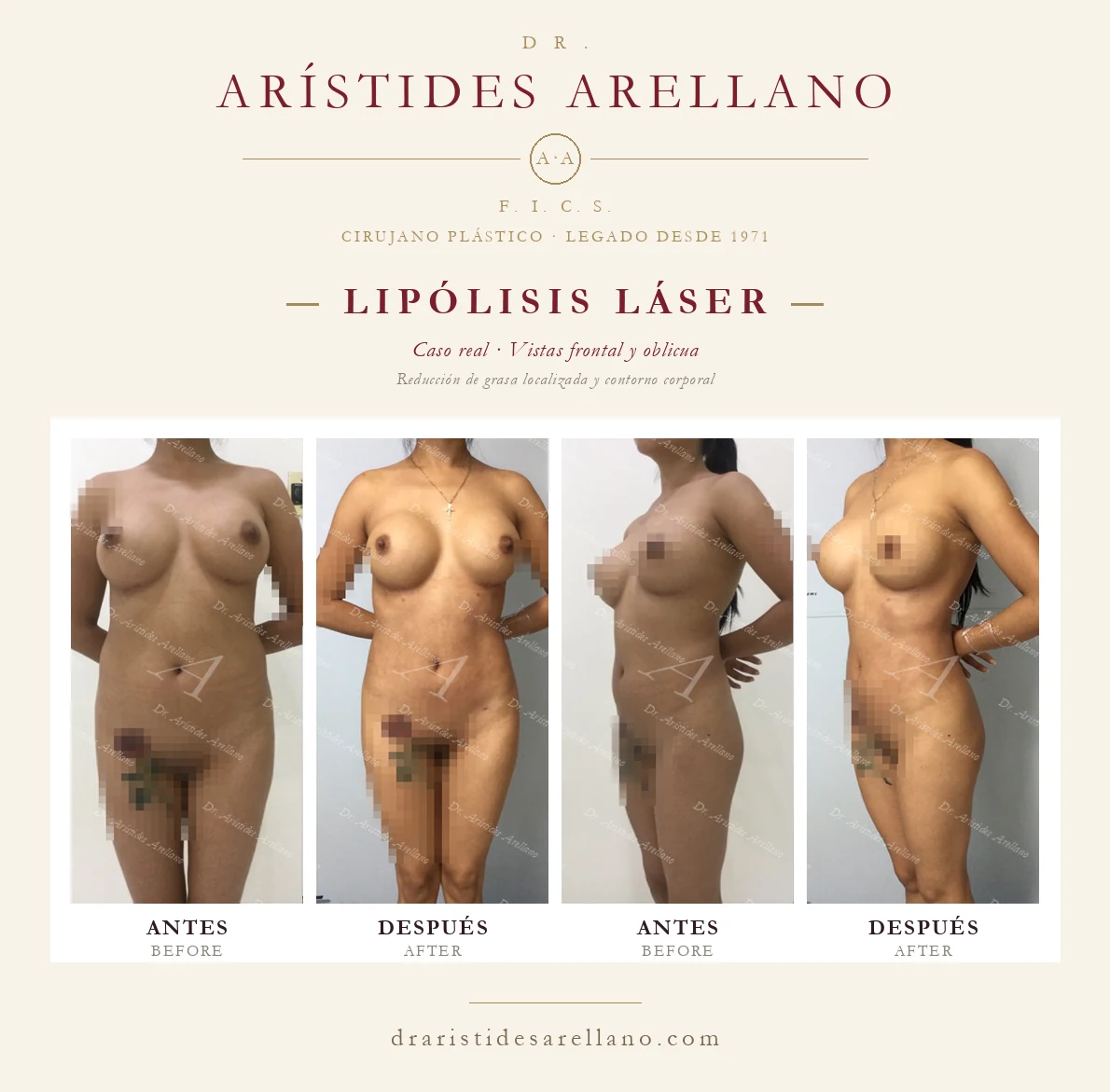 Laser lipolysis — frontal and oblique before and after, localized fat reduction and body contouring, real case by Dr. Arístides Arellano in Puebla