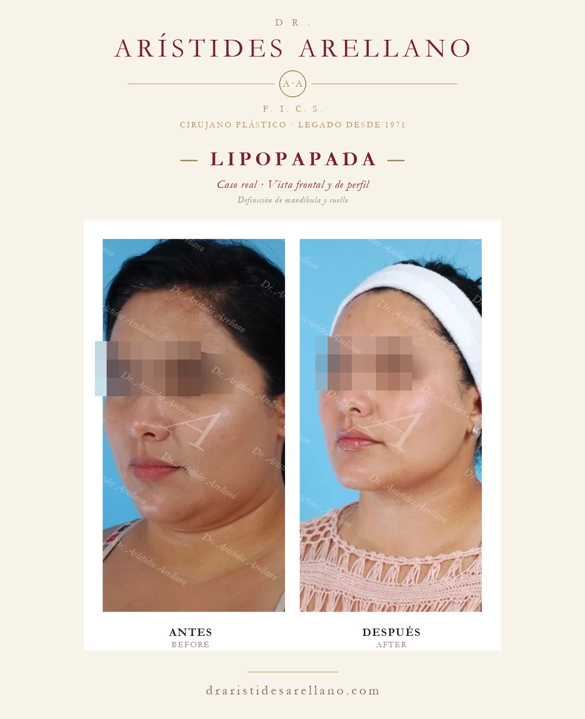 Submental liposuction in Puebla — frontal and profile view — jawline and neck definition, before and after by Dr. Arístides Arellano